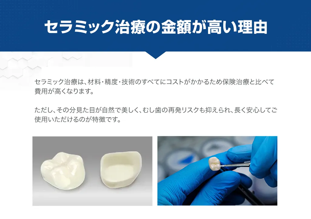 セラミック治療の金額が高い理由